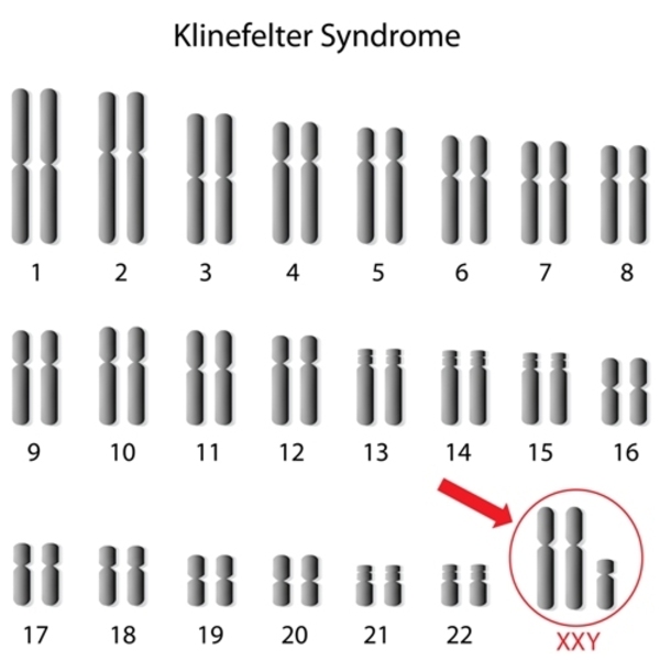 klinefelter-syndrome-karyotype